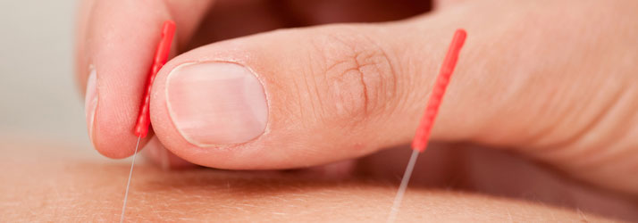 Chiropractic Falls Church VA Dry Needling